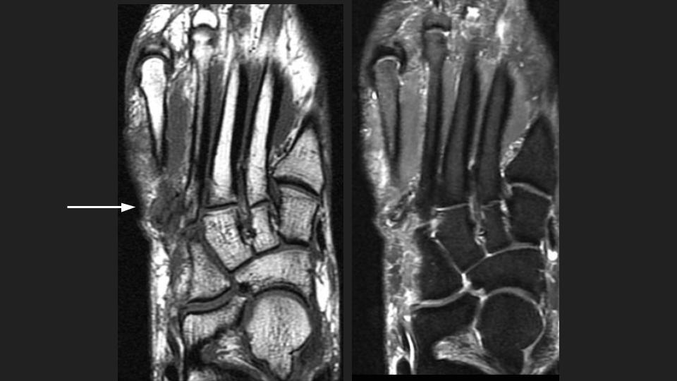 Figure 3 for case peroneus tertius ( RID2915 )